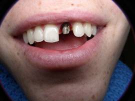 שתל במקום שן קדמית שאבדה